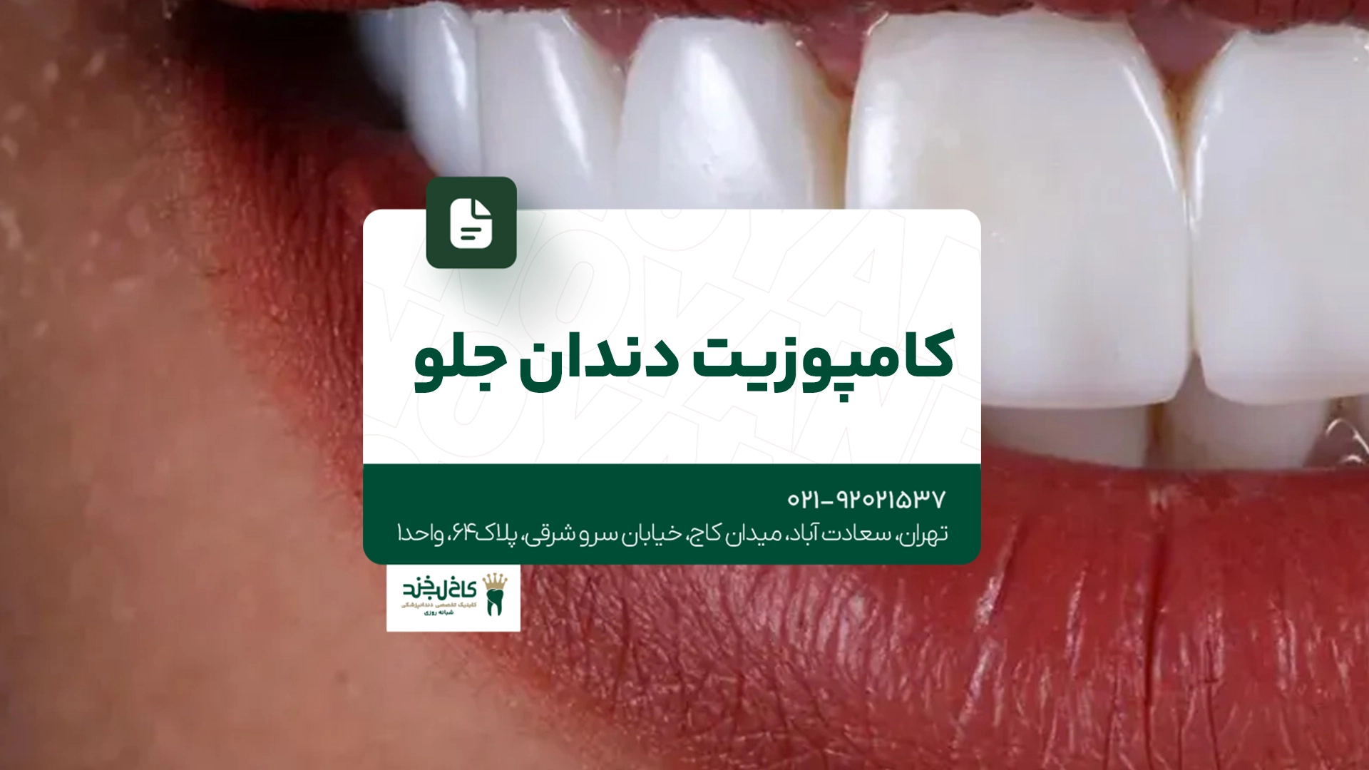 کامپوزیت دندان جلو