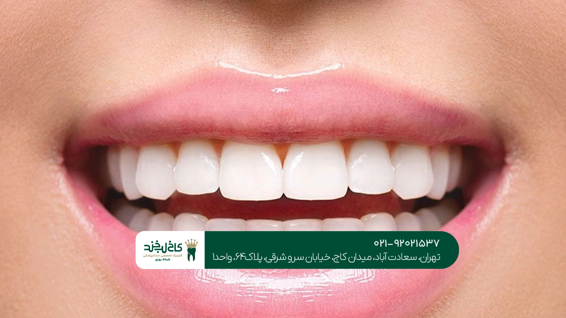 کامپوزیت دندان جلو با قیمت مناسب