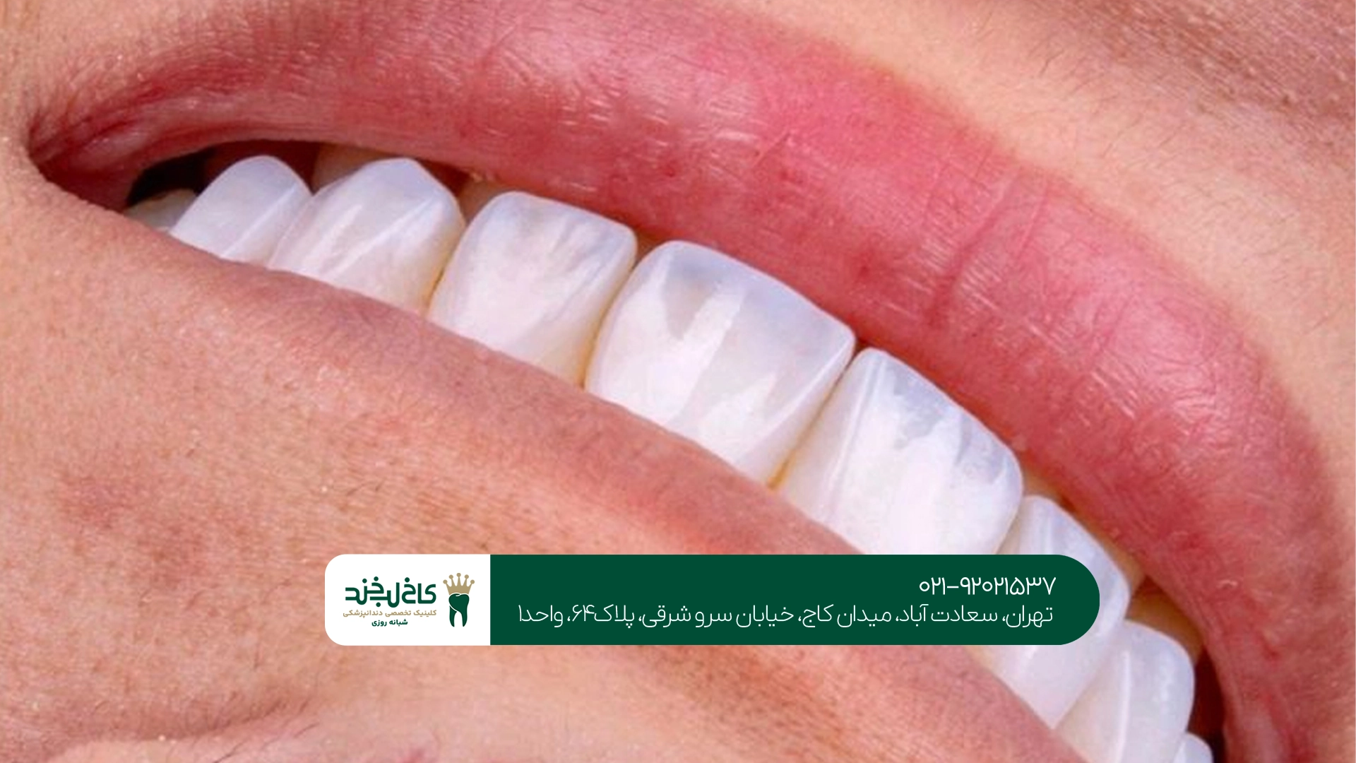 کامپوزیت سارمکو با نتیجه طبیعی