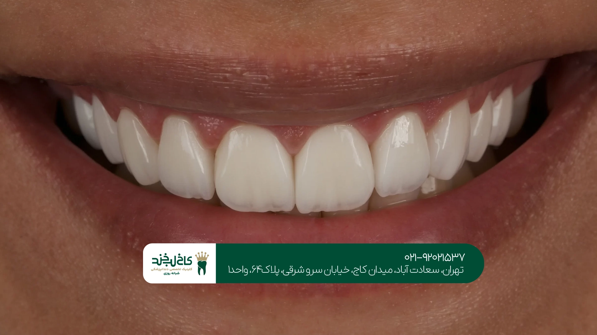 کامپوزیت نچرال در تهران کامپوزیت نچرال در تهران