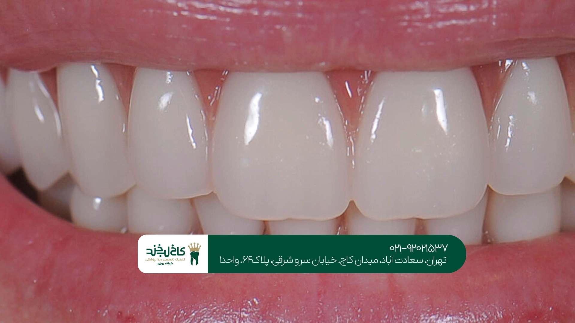 کامپوزیت دندان در تهران کامپوزیت دندان در تهران