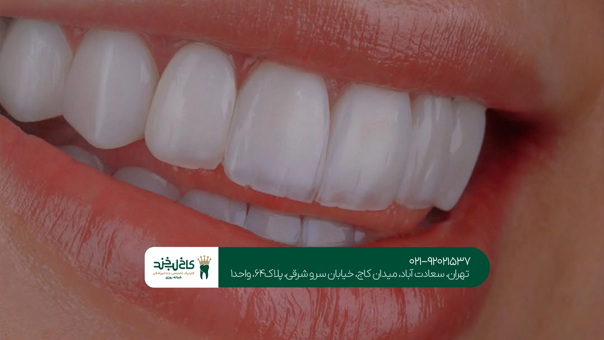 کامپوزیت دندان کامپوزیت دندان