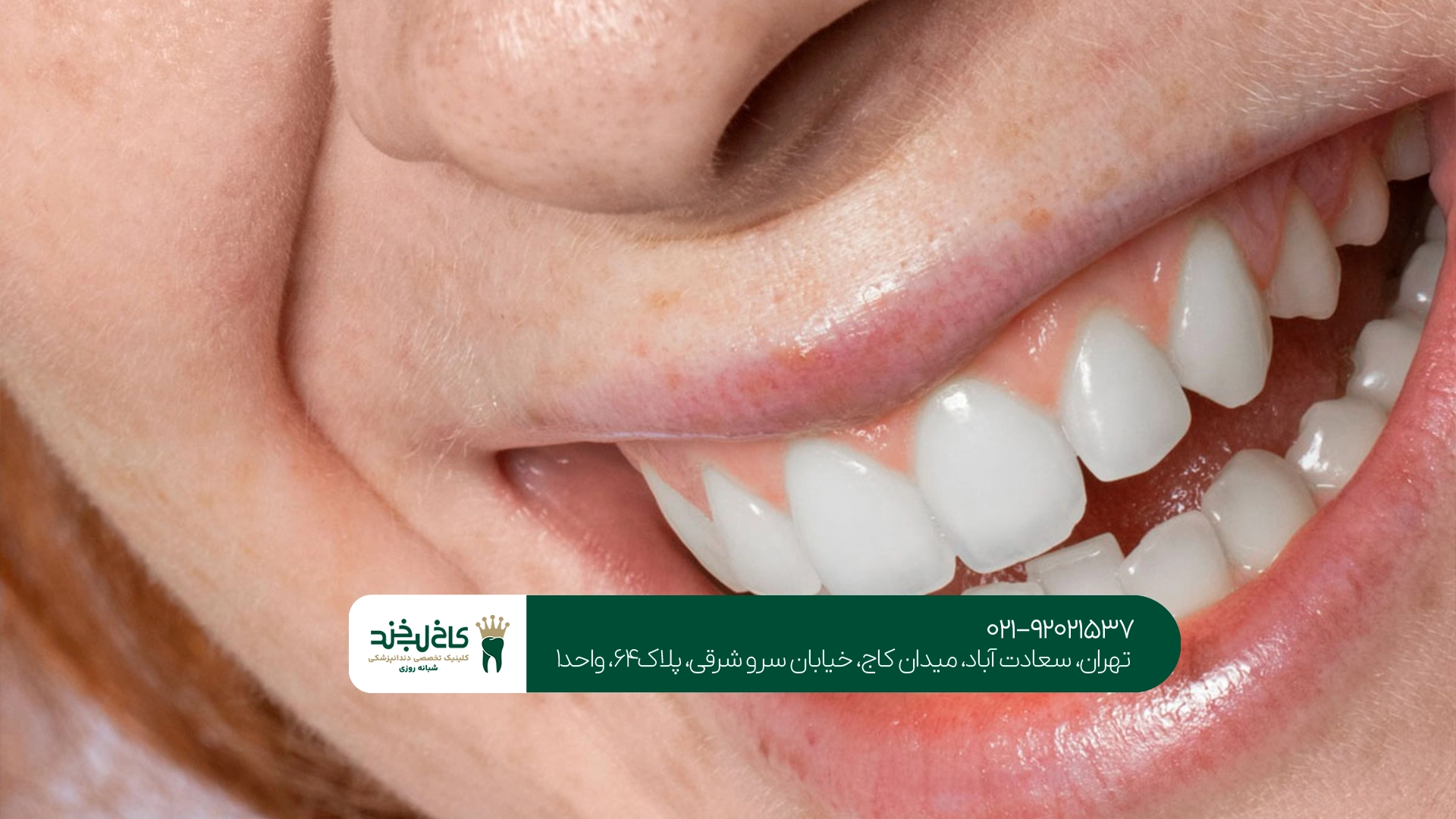 ماندگاری کامپوزیت دندان در غرب تهران چقدر است؟