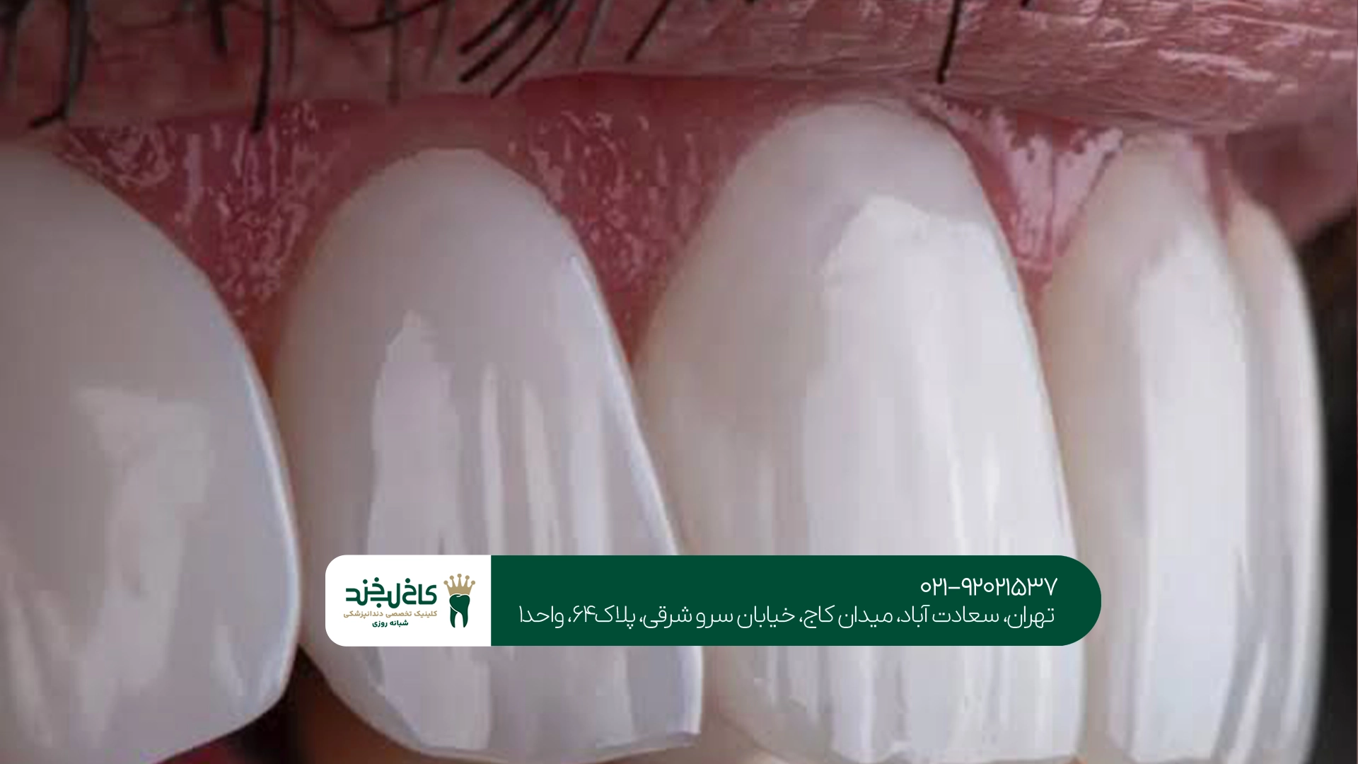 کامپوزیت لیرینگ در تهران کامپوزیت لیرینگ در تهران