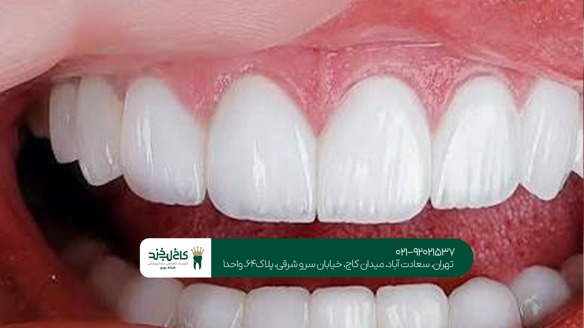 قیمت کامپوزیت لیرینگ قیمت کامپوزیت لیرینگ