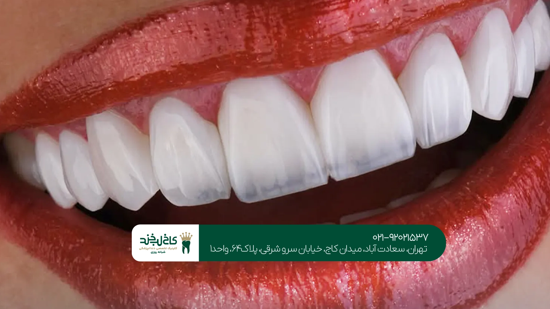 مزایای کامپوزیت لیرینگ مزایای کامپوزیت لیرینگ
