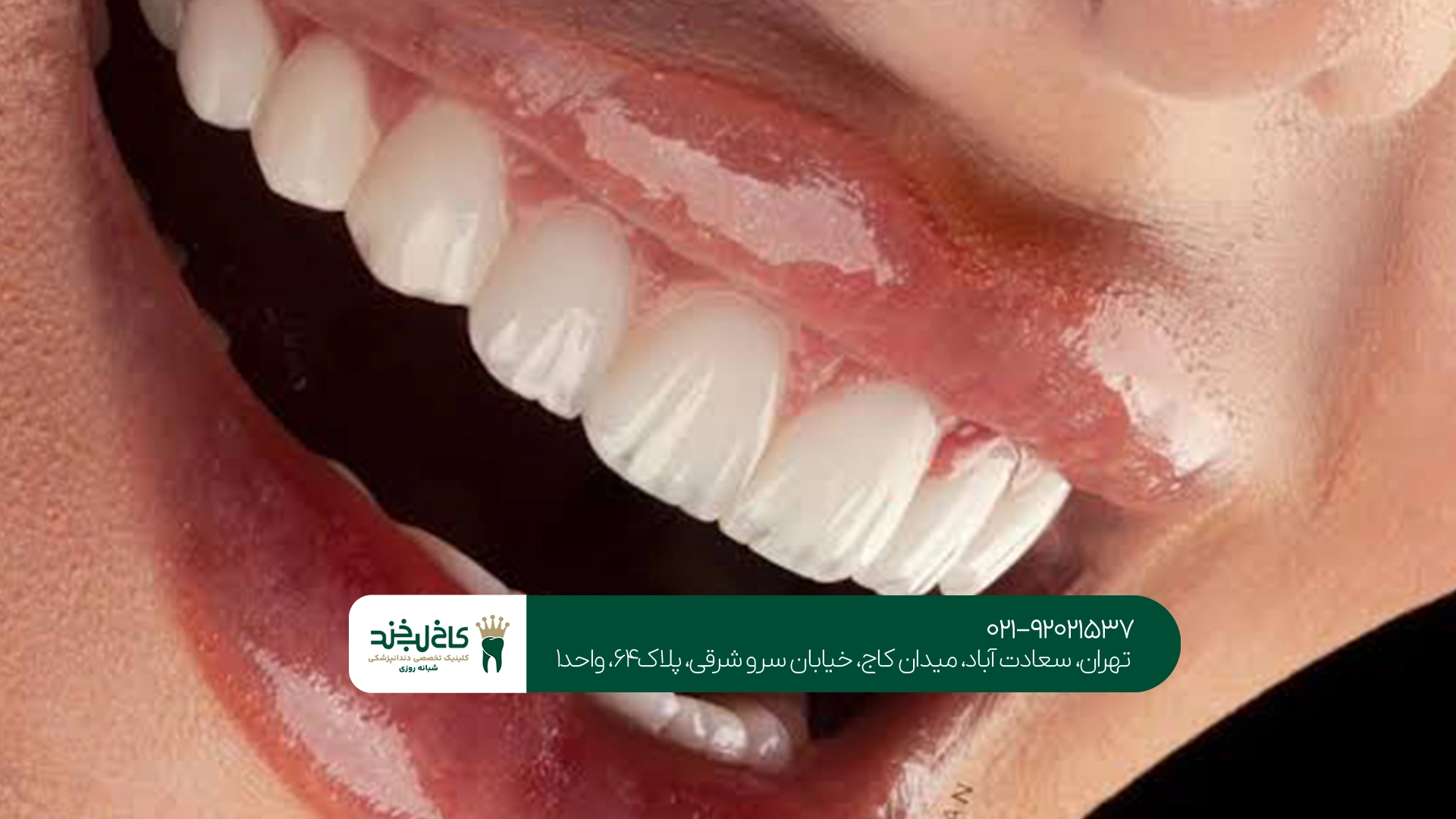 مزایای کامپوزیت نچرال چیست؟ مزایای کامپوزیت نچرال چیست؟