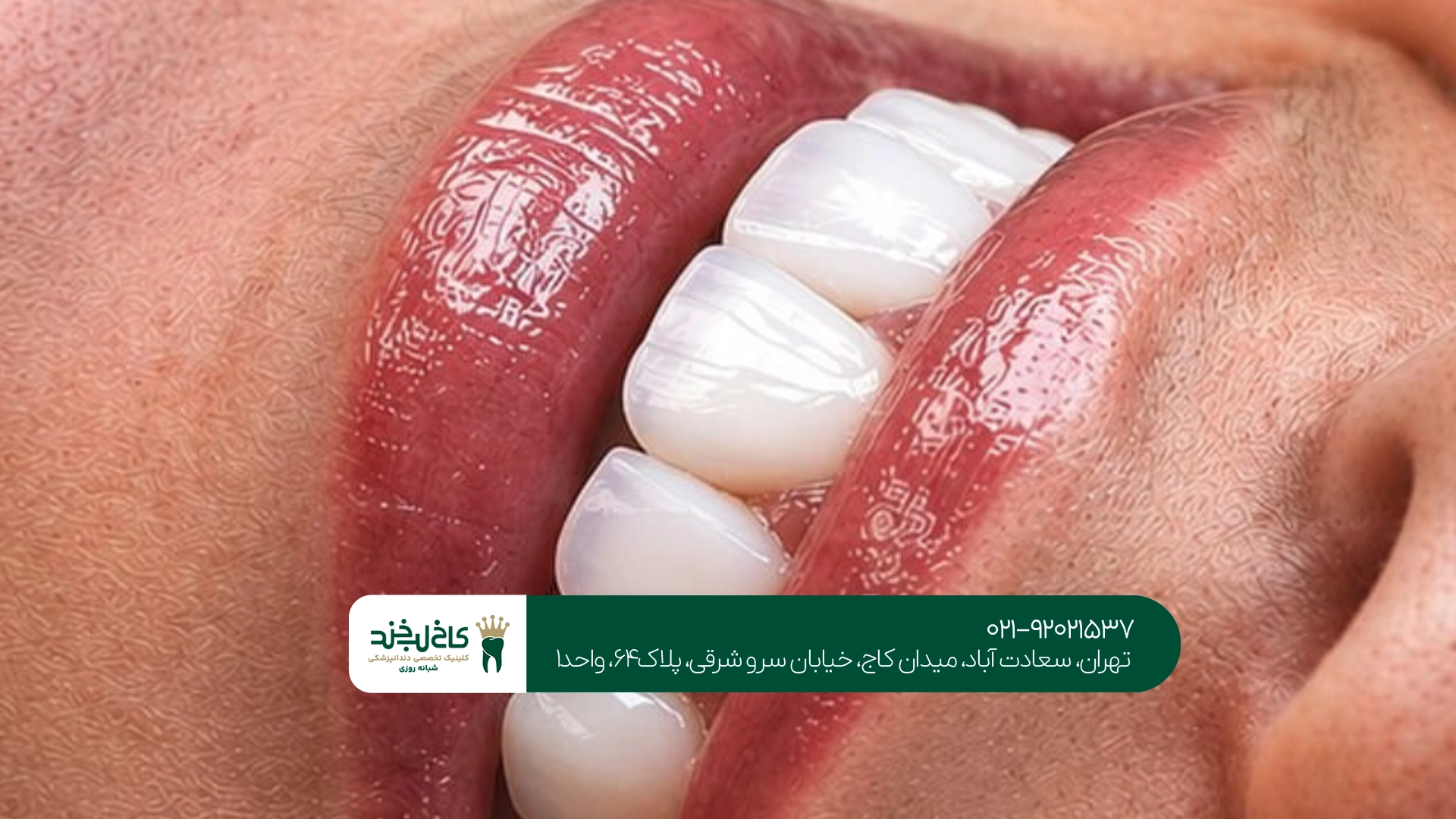 ماندگاری کامپوزیت نچرال ماندگاری کامپوزیت نچرال