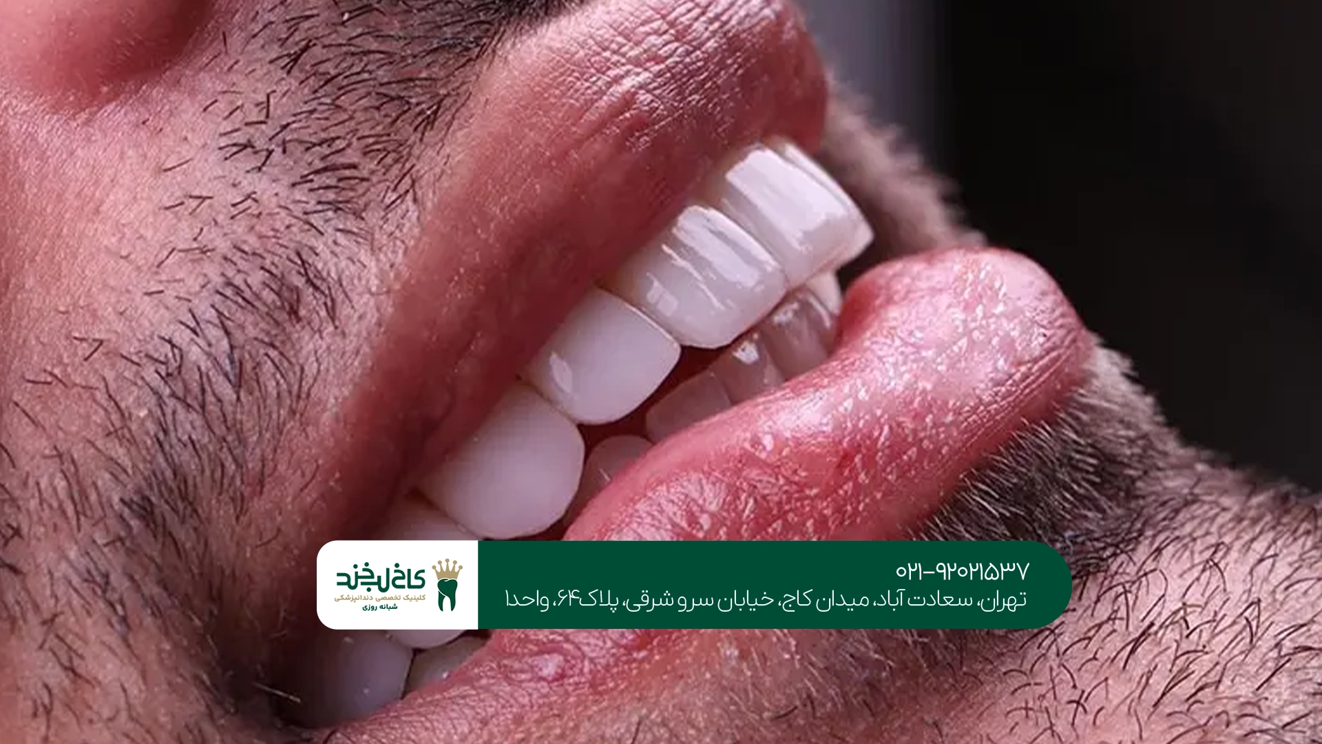 بهترین کامپوزیت نچرال در تهران بهترین کامپوزیت نچرال در تهران