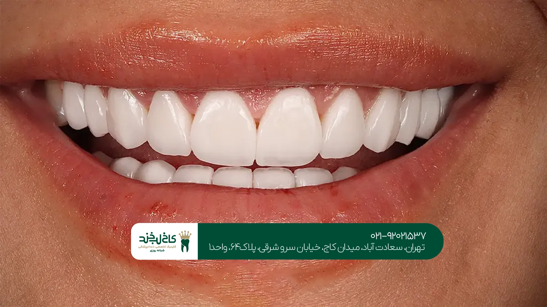 ماندگاری کامپوزیت کاریزما
