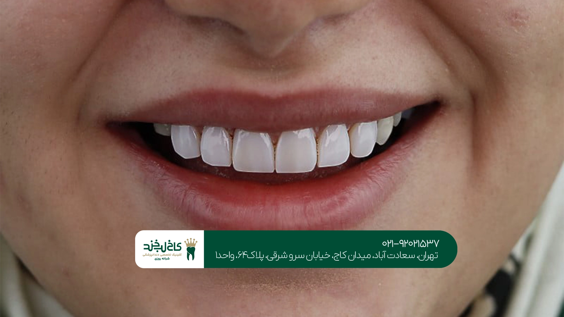 بهترین کلینیک کامپوزیت کاریزما