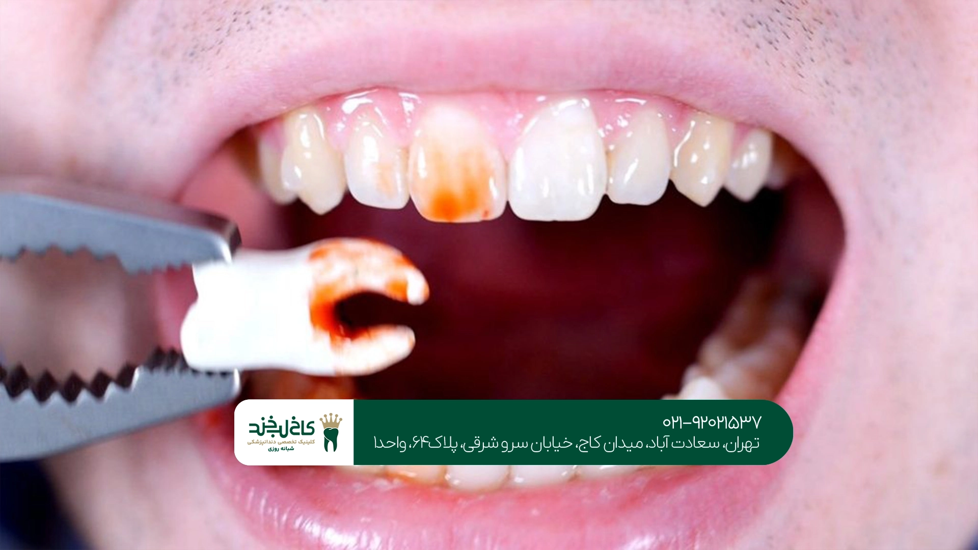 چگونه بعد از کشیدن دندان عقل درد کمتری داشته باشیم؟