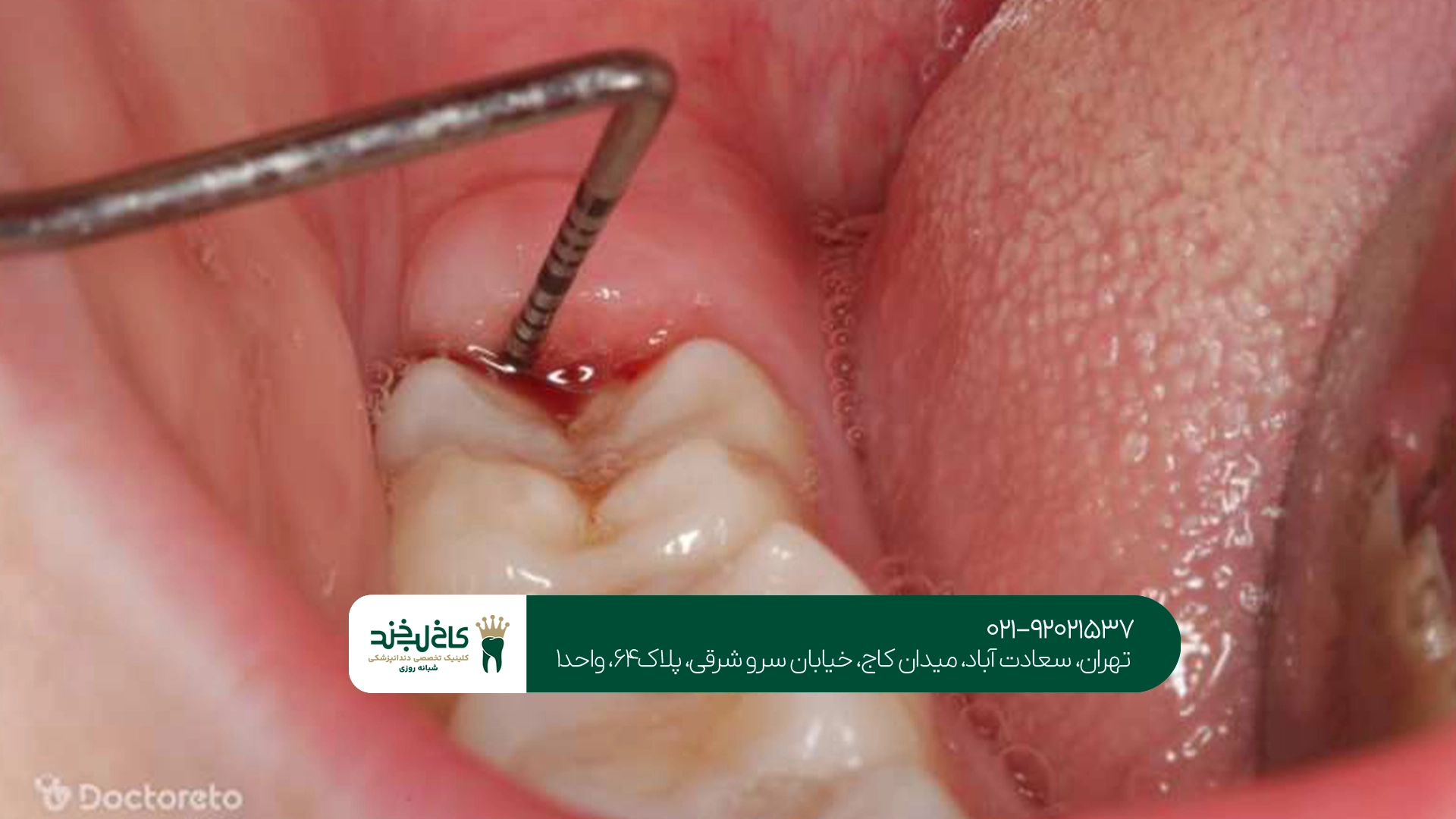 کلینیک جراحی دندان عقل