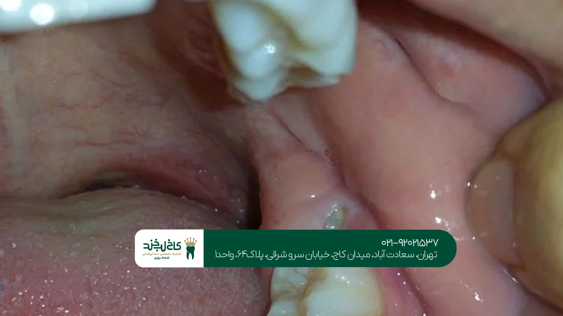 کشیدن دندان عقل نهفته چقدر درد دارد؟