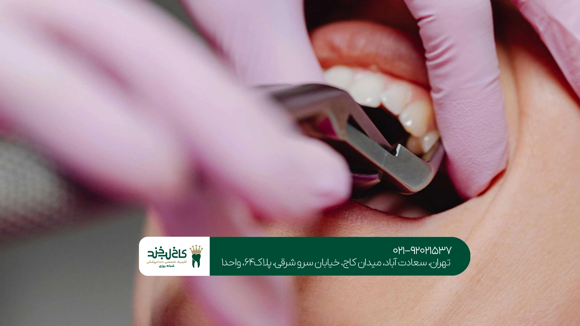 لخته خون بعد از کشیدن دندان چرا مهم است؟ لخته خون بعد از کشیدن دندان چرا مهم است؟