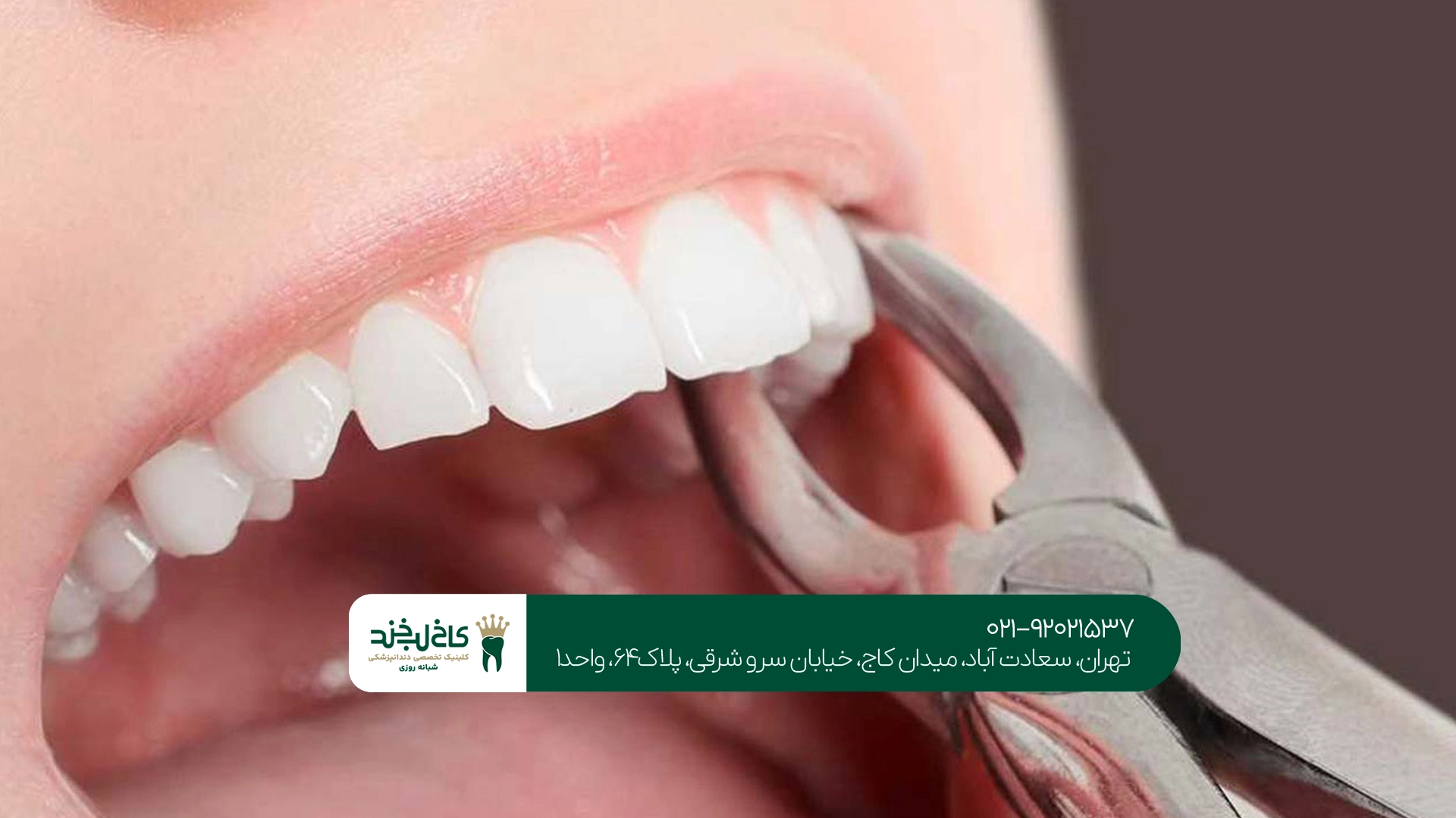 آیا بعد از کشیدن دندان باید آن را جایگزین کرد؟ آیا بعد از کشیدن دندان باید آن را جایگزین کرد؟