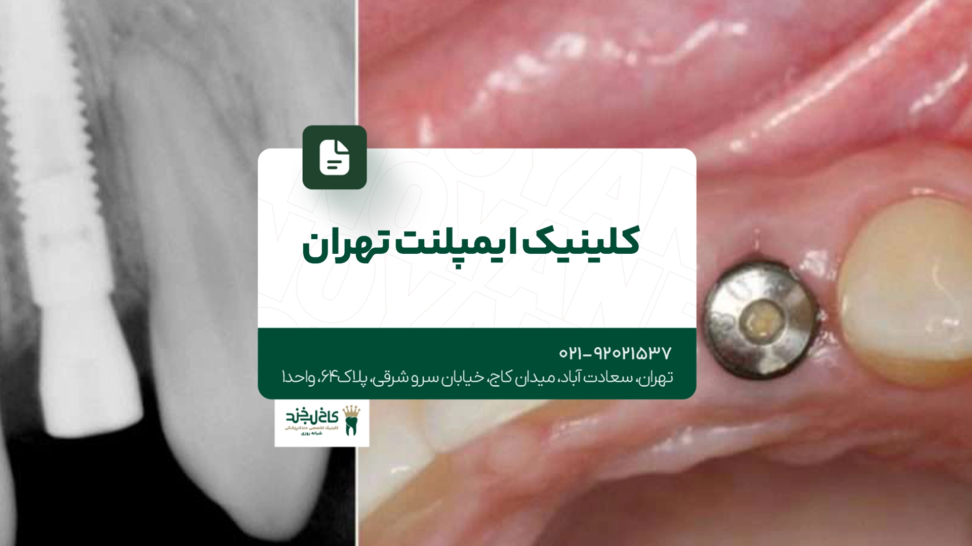 کلینیک ایمپلنت تهران