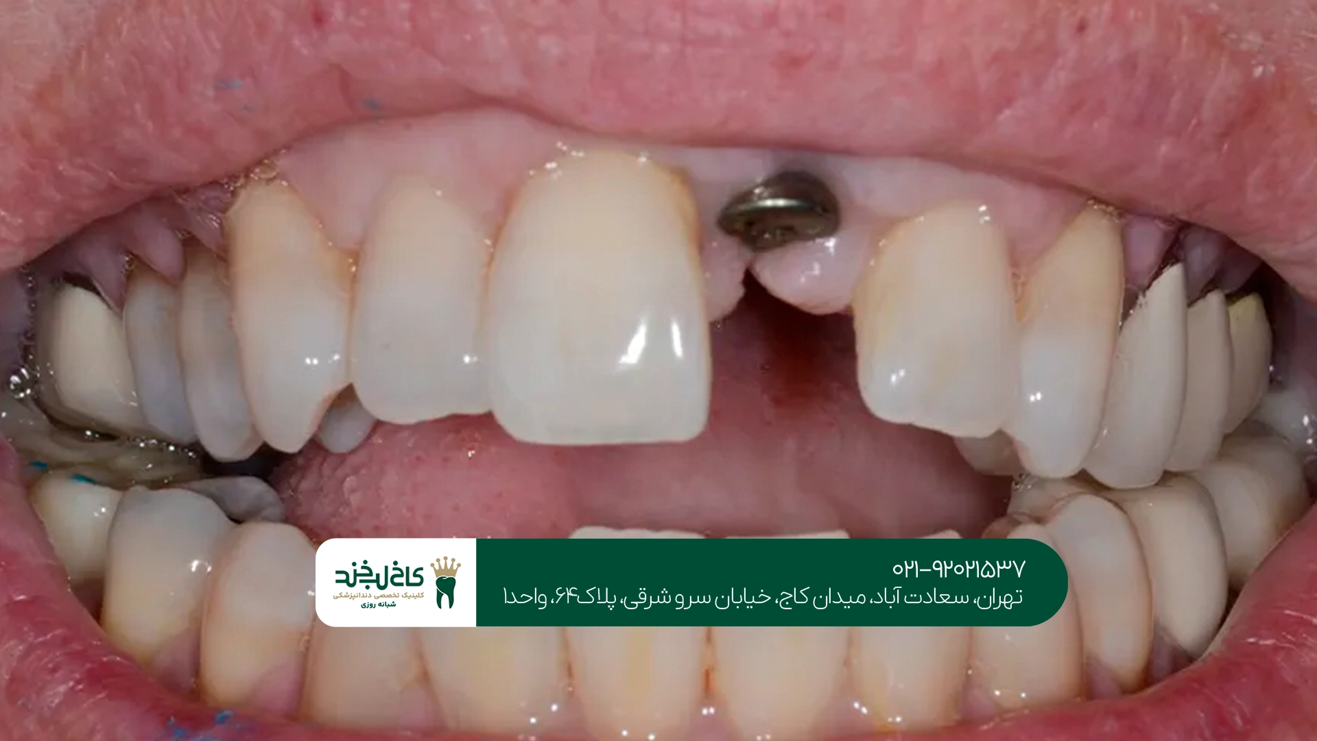 کلینیک ایمپلنت تهران با تجهیزات مدرن