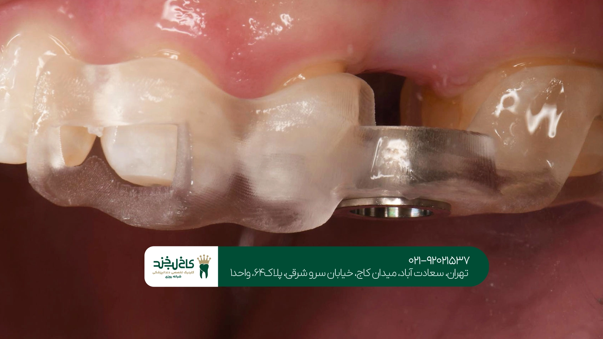 هزینه ایمپلنت در کلینیکهای تهران چگونه محاسبه میشود؟