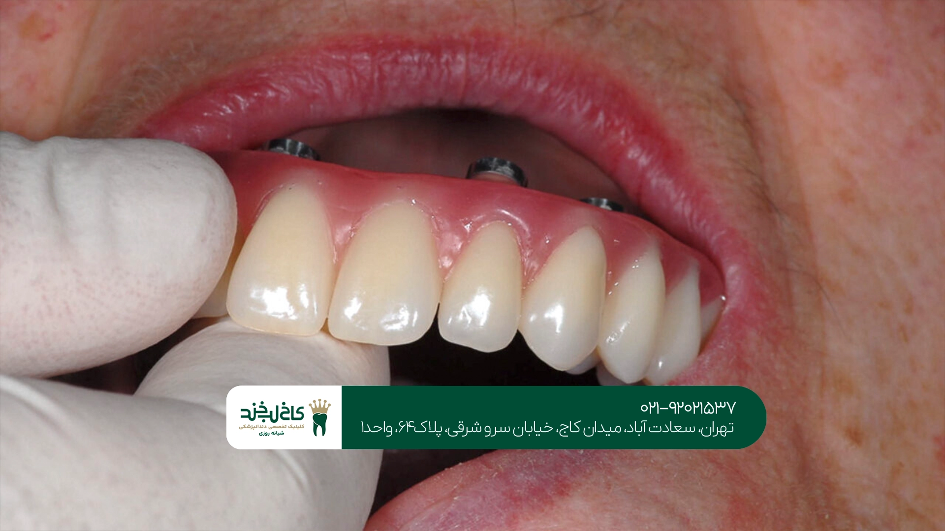 ایمپلنت دندان در سعادت آباد ایمپلنت دندان در سعادت آباد