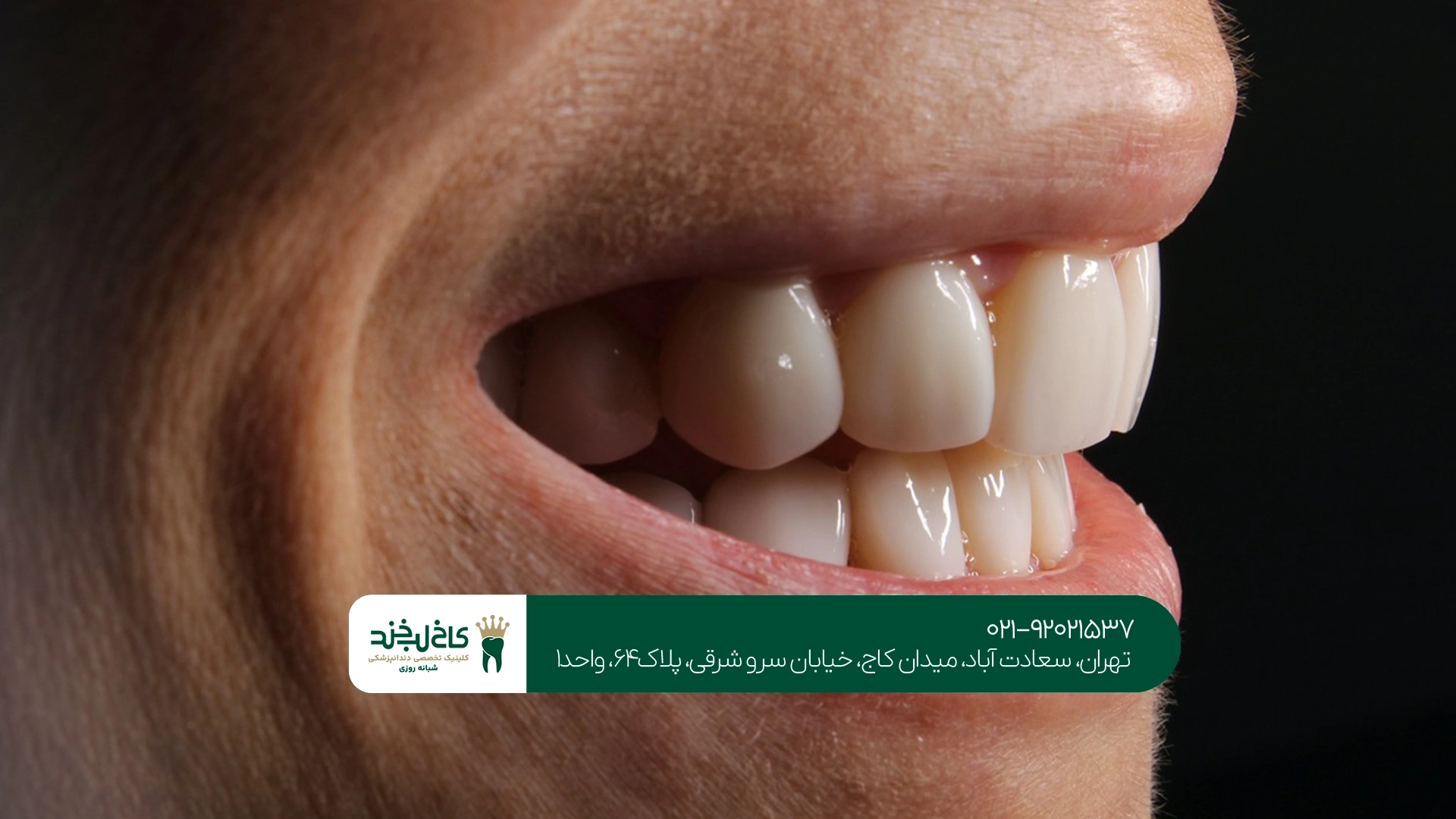 کلینیک زیبایی دندان برای کامپوزیت و لمینت