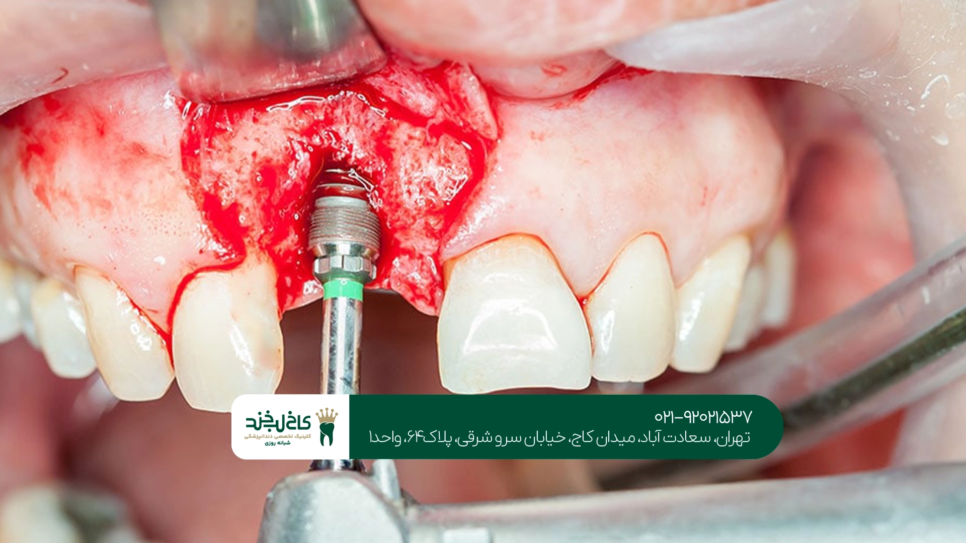 کلینیک مجهز ایمپلنت دندان