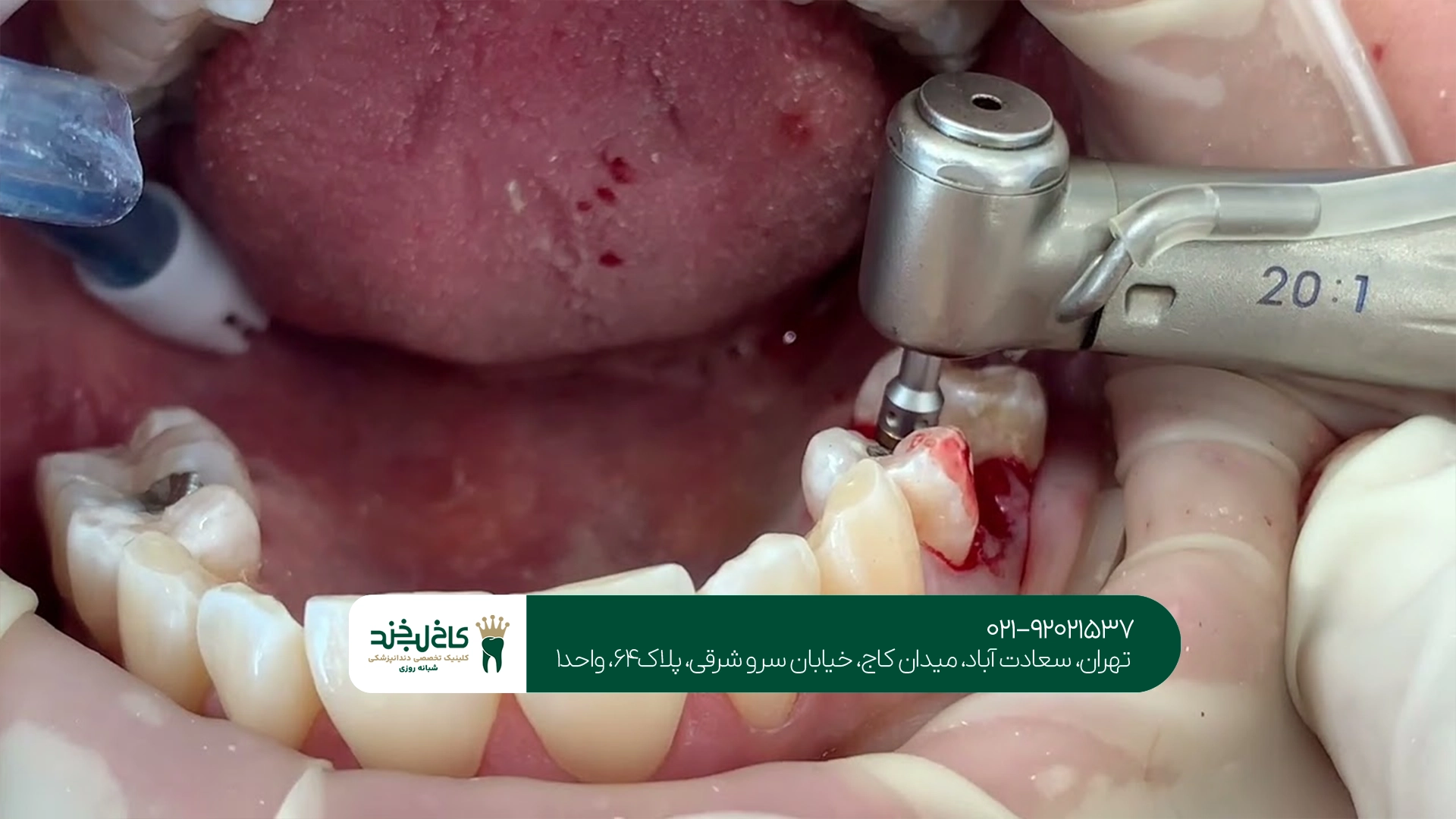 کلینیک ایمپلنت با گارانتی