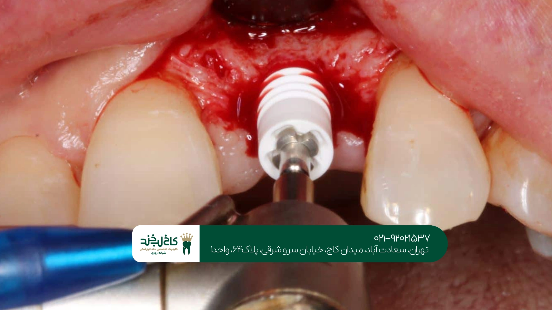 گارانتی ایمپلنت چه مواردی را پوشش میدهد؟