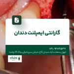گارانتی ایمپلنت دندان