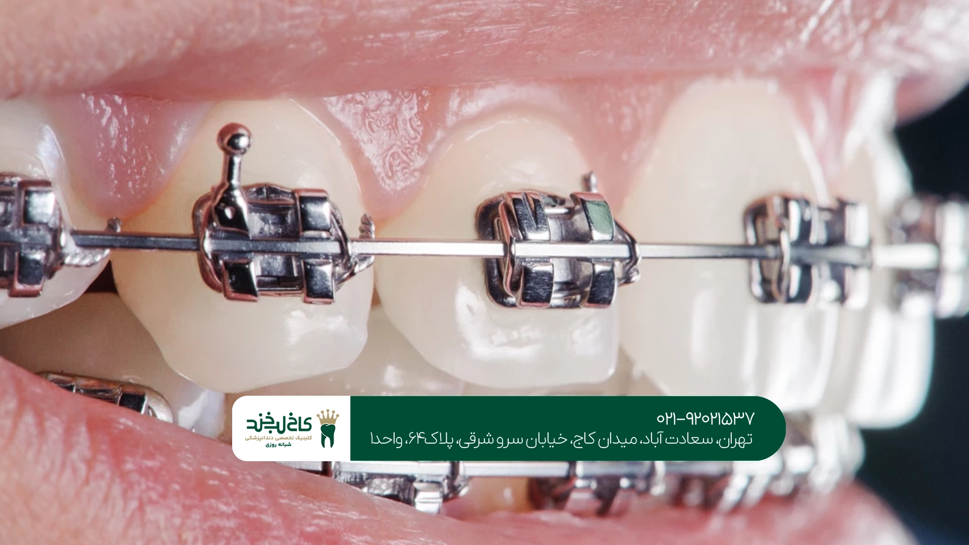 هزینه ارتودنسی اقساطی تهران چقدر است؟