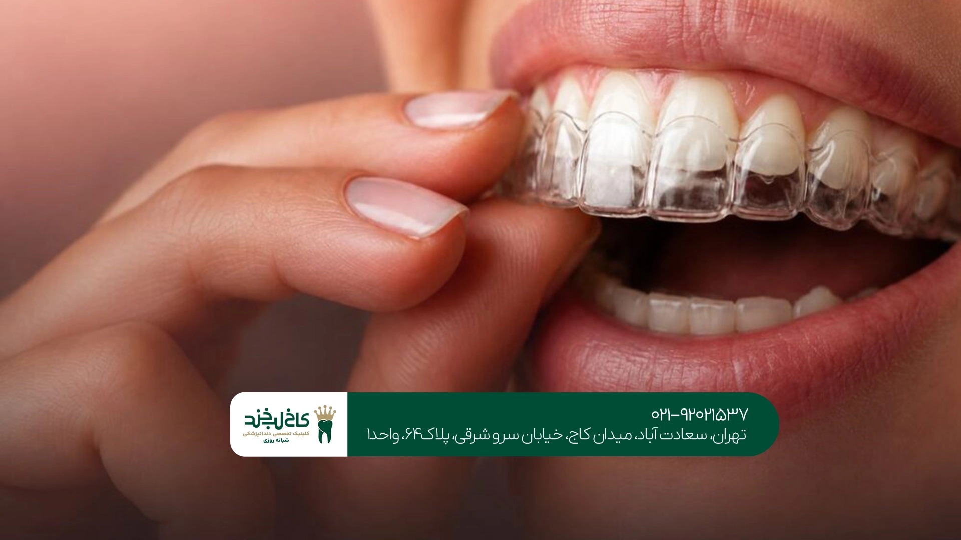 ارتودنسی با الاینر چقدر طول میکشد ارتودنسی با الاینر چقدر طول میکشد