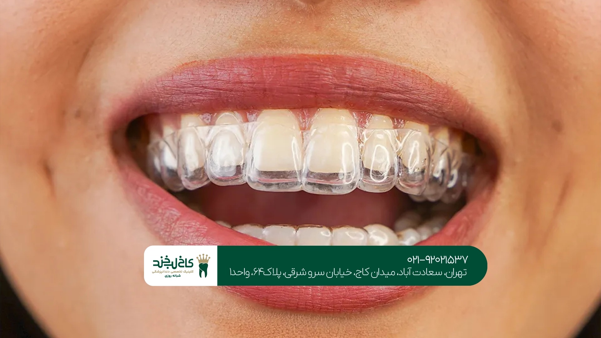 قیمت ارتودنسی با الاینر قیمت ارتودنسی با الاینر