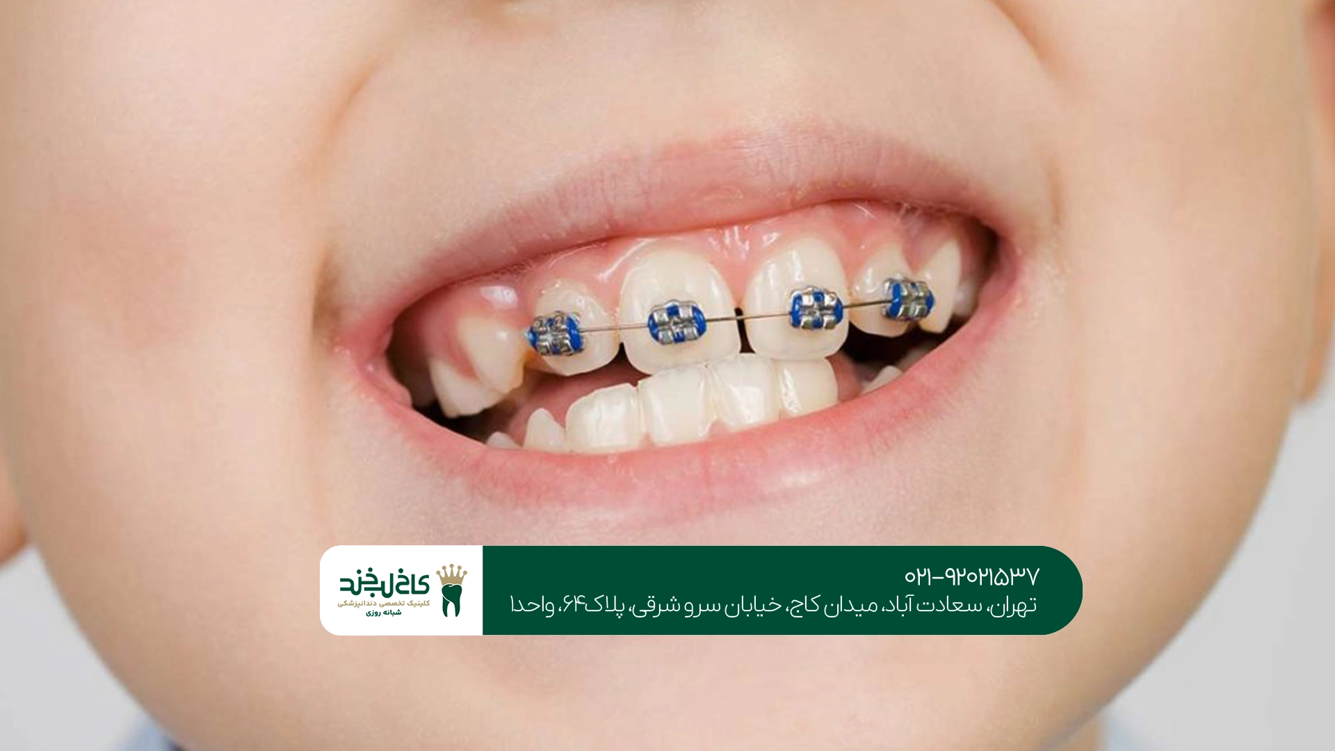 هزینه ارتودنسی کودکان در تهران چقدر است؟