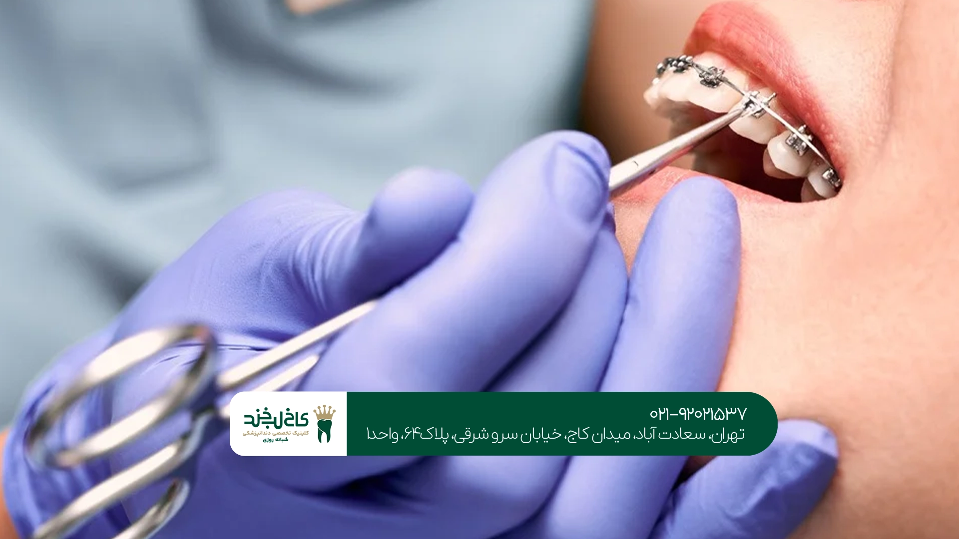 ارتودنسی دندان جلو بدون کشیدن دندان