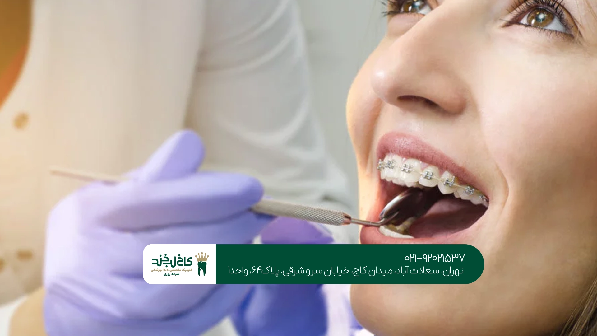 ارتودنسی دندانهای جلویی چگونه انجام میشود؟