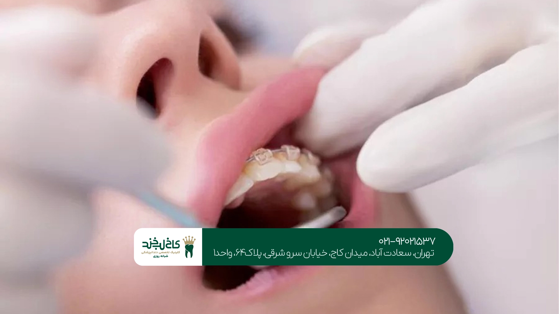 نتیجه ارتودنسی دندان چقدر ماندگار است؟