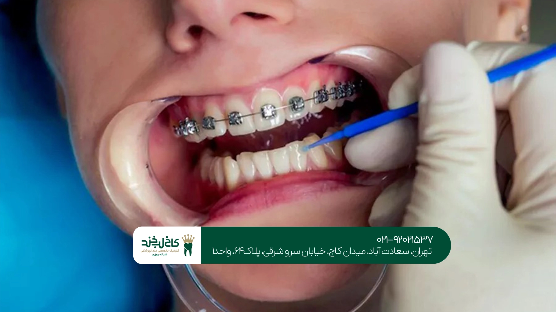 ارتودنسی دندان برای بزرگسالان