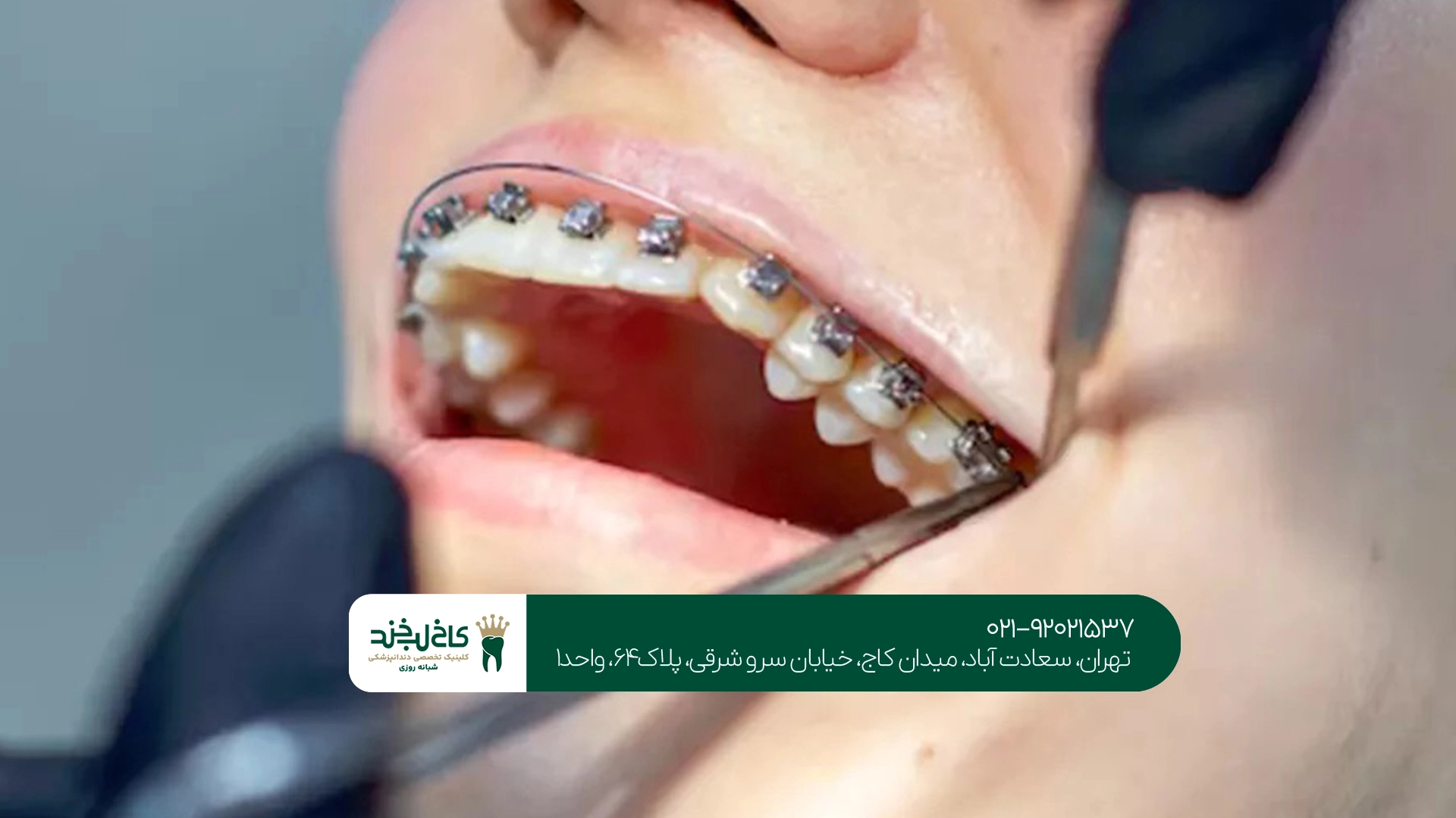 ارتودنسی دندان چقدر طول میکشد؟