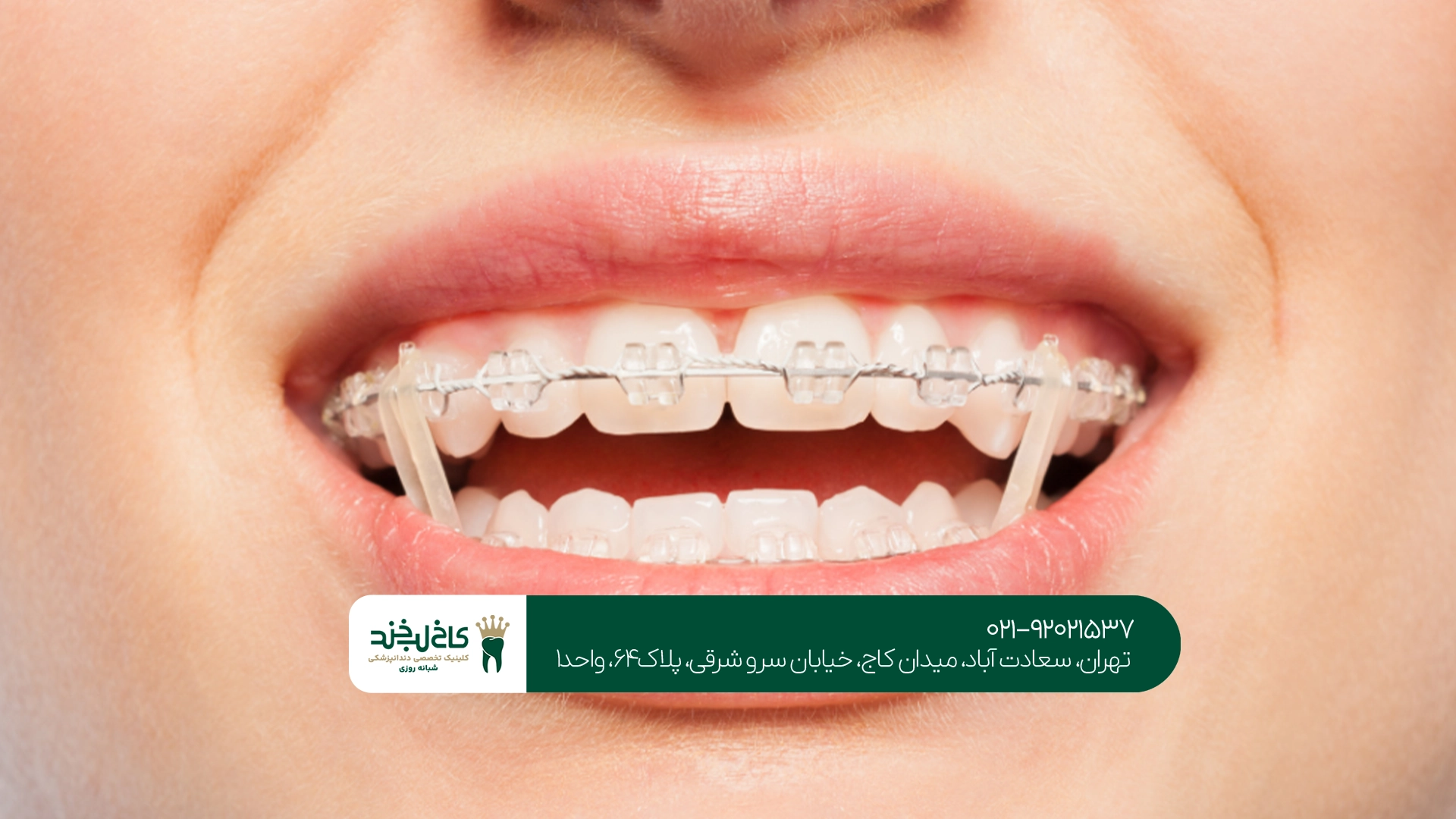 اصلاح طرح لبخند با ارتودنسی سریع