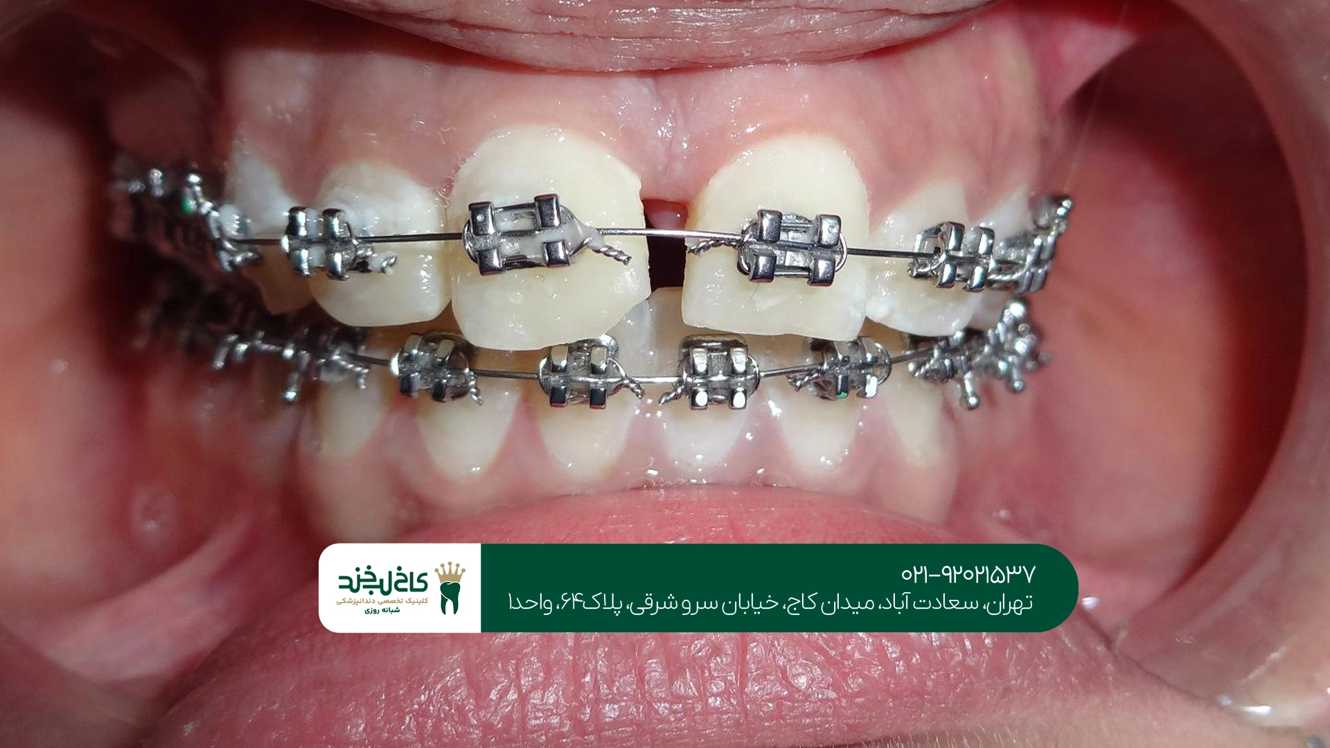 هزینه ارتودنسی سریع چقدر است؟