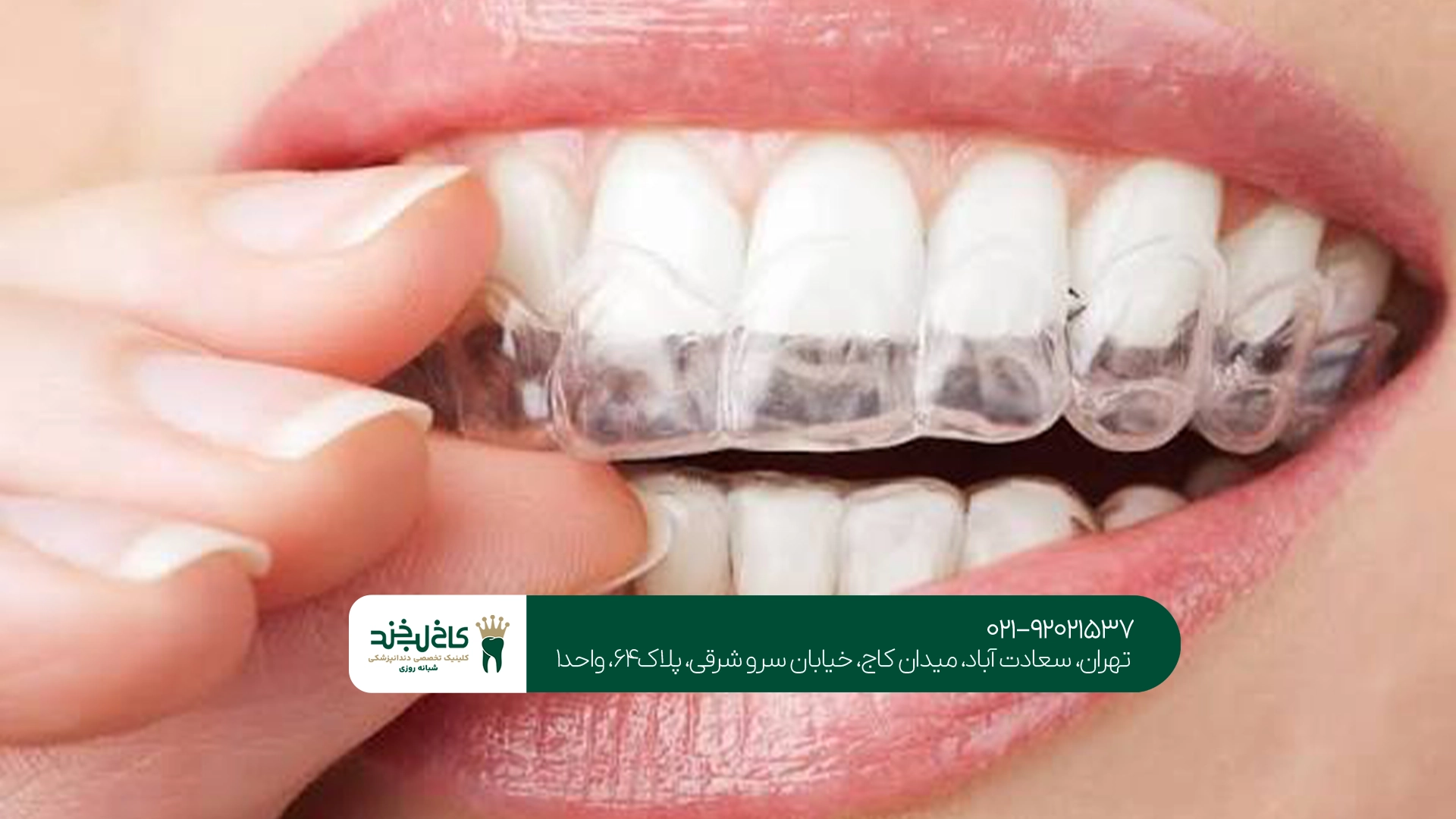 قیمت ارتودنسی شفاف قیمت ارتودنسی شفاف