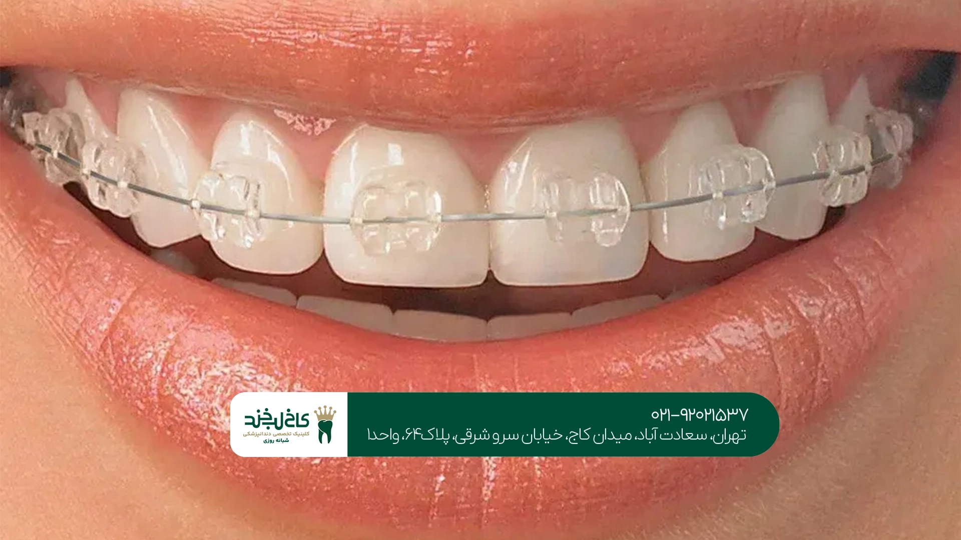 ارتودنسی نامرئی ارتودنسی نامرئی