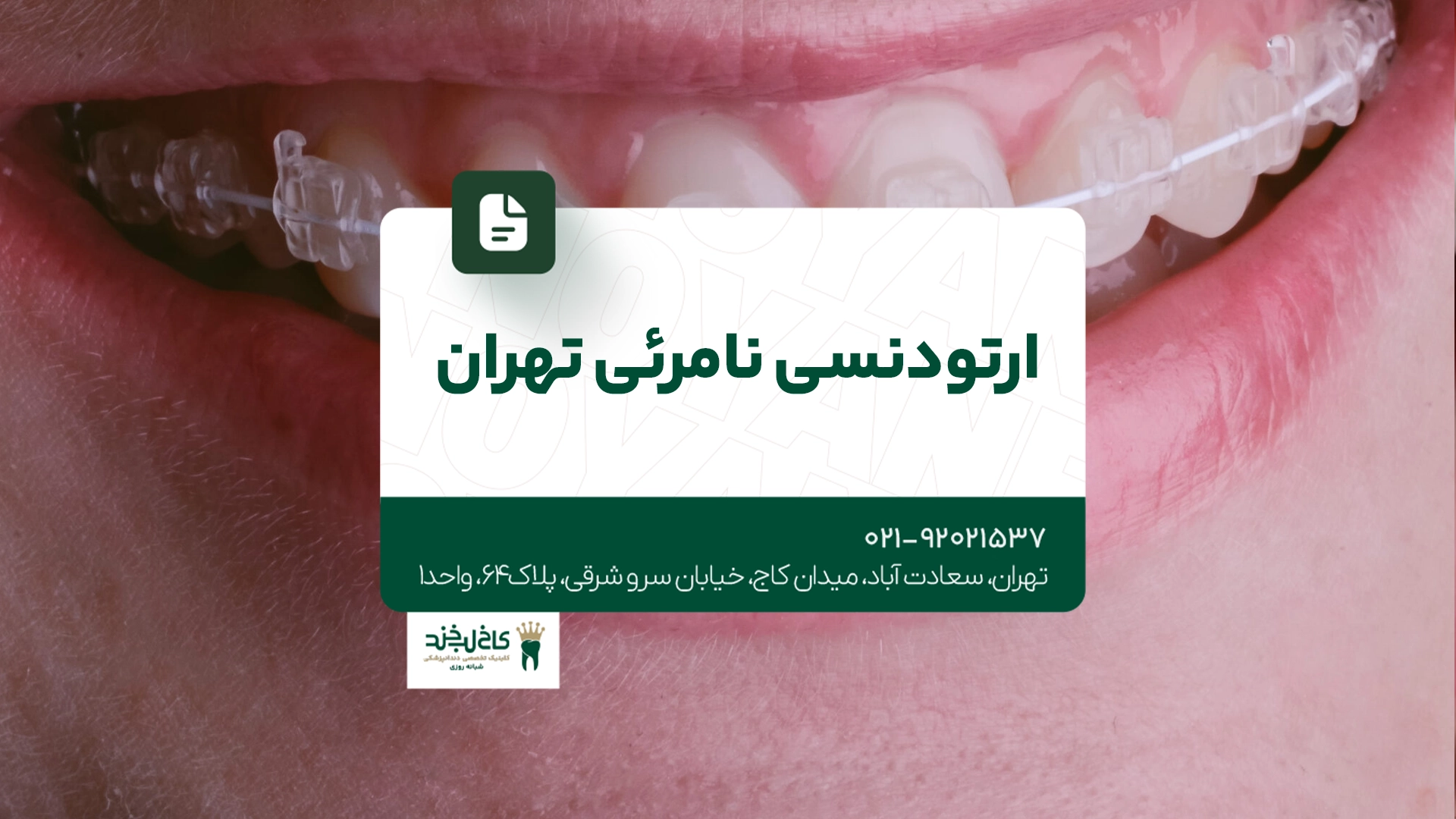 ارتودنسی نامرئی تهران ارتودنسی نامرئی تهران