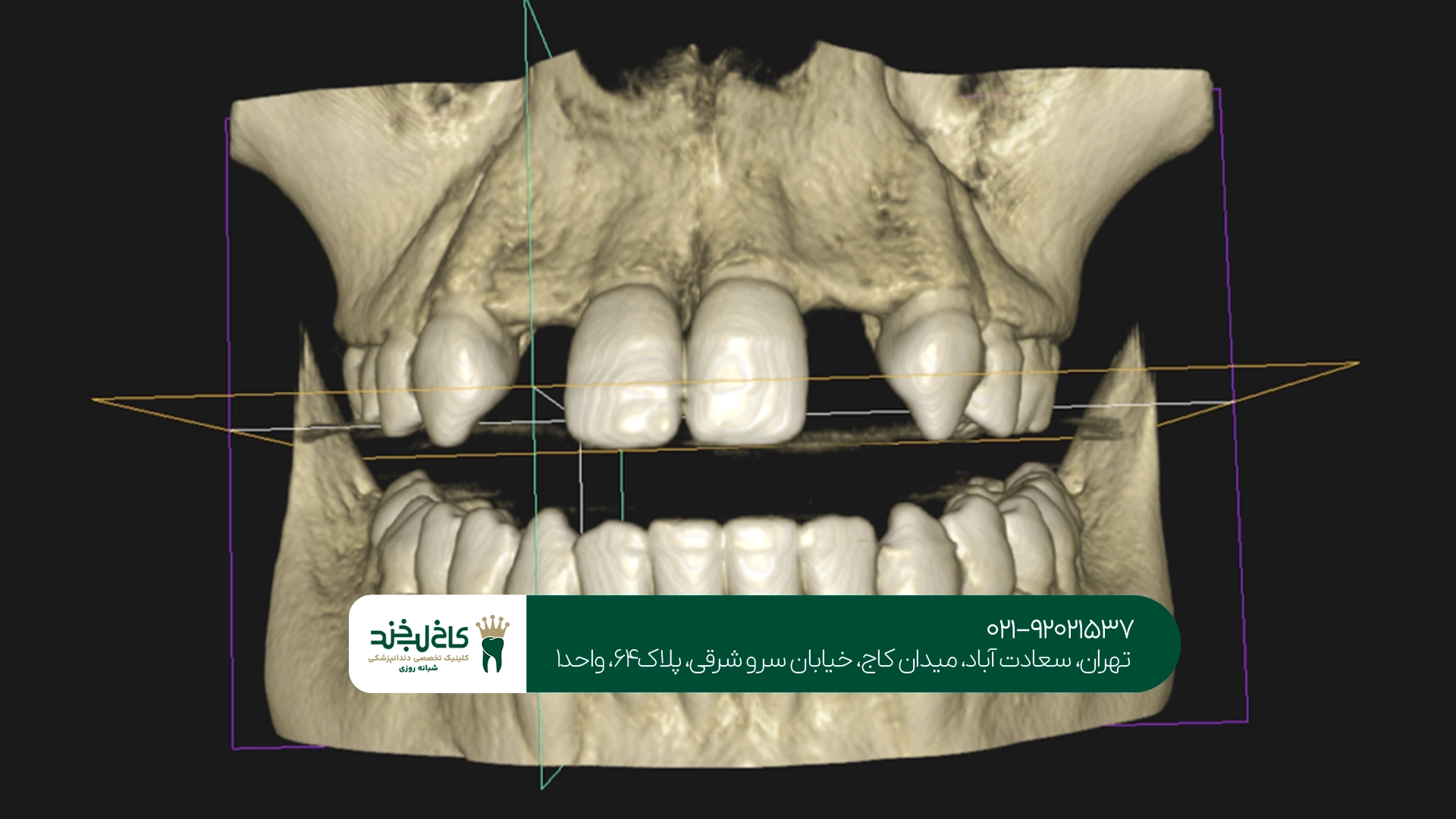 اسکن سه بعدی دندان در تهران