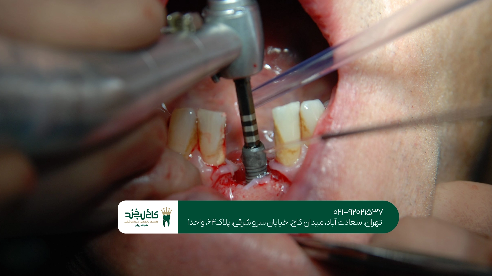ایمپلنت بدون بخیه چه شرایطی دارد؟