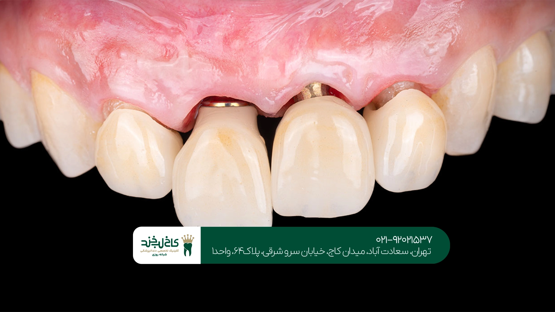 مراحل کاشت دندان بدون جراحی