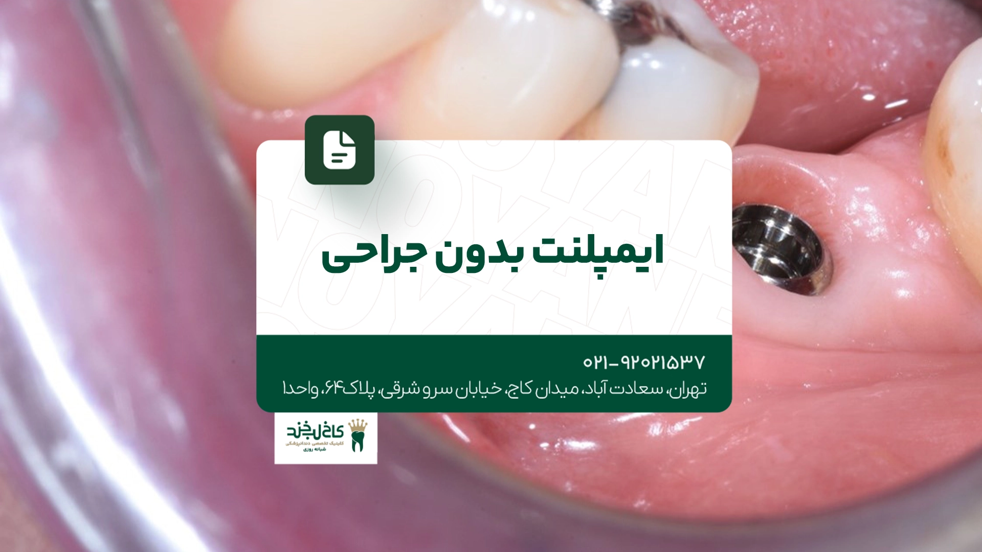 ایمپلنت بدون جراحی