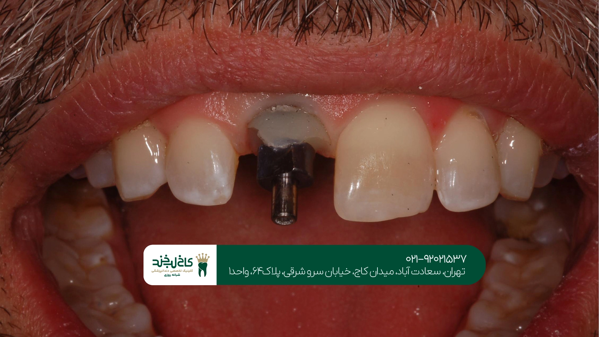 ماندگاری ایمپلنت فوری چقدر است؟