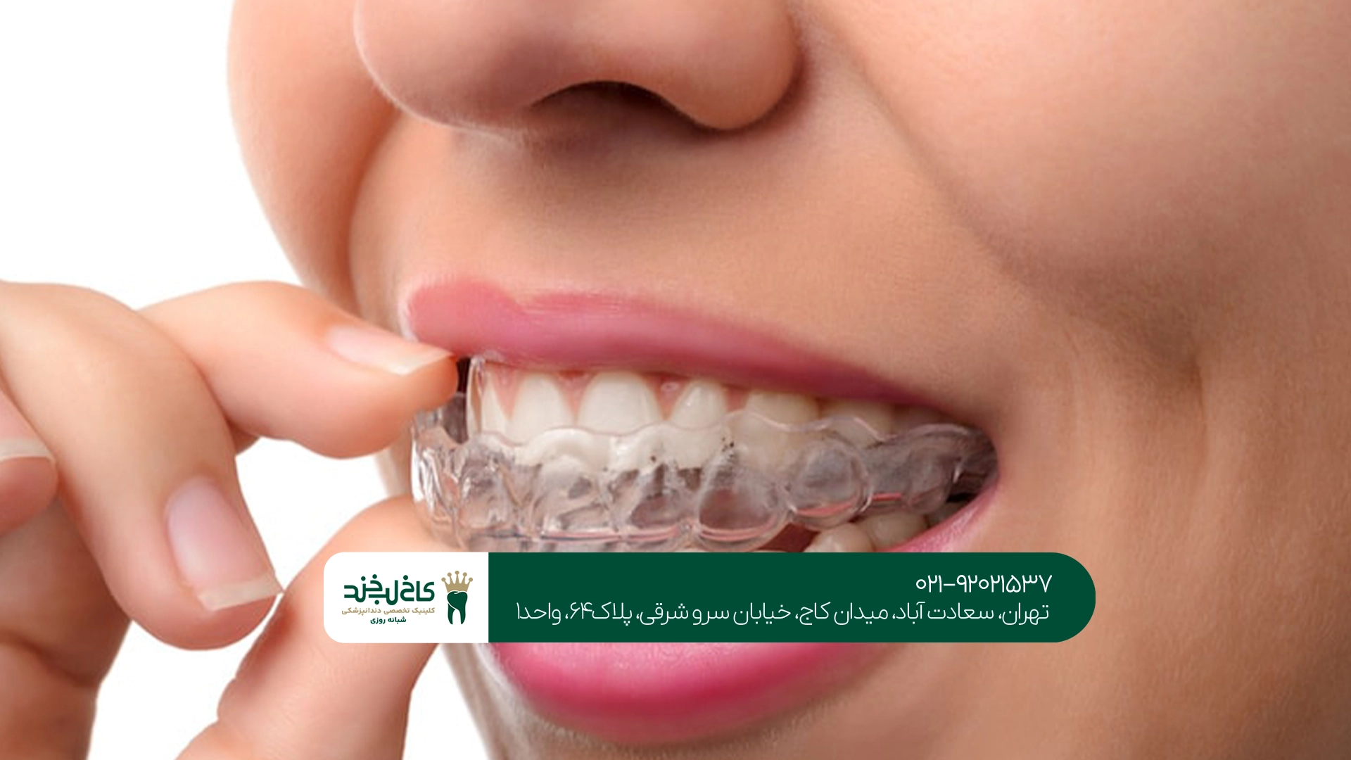 اینویزیلاین یا ارتودنسی ثابت؟