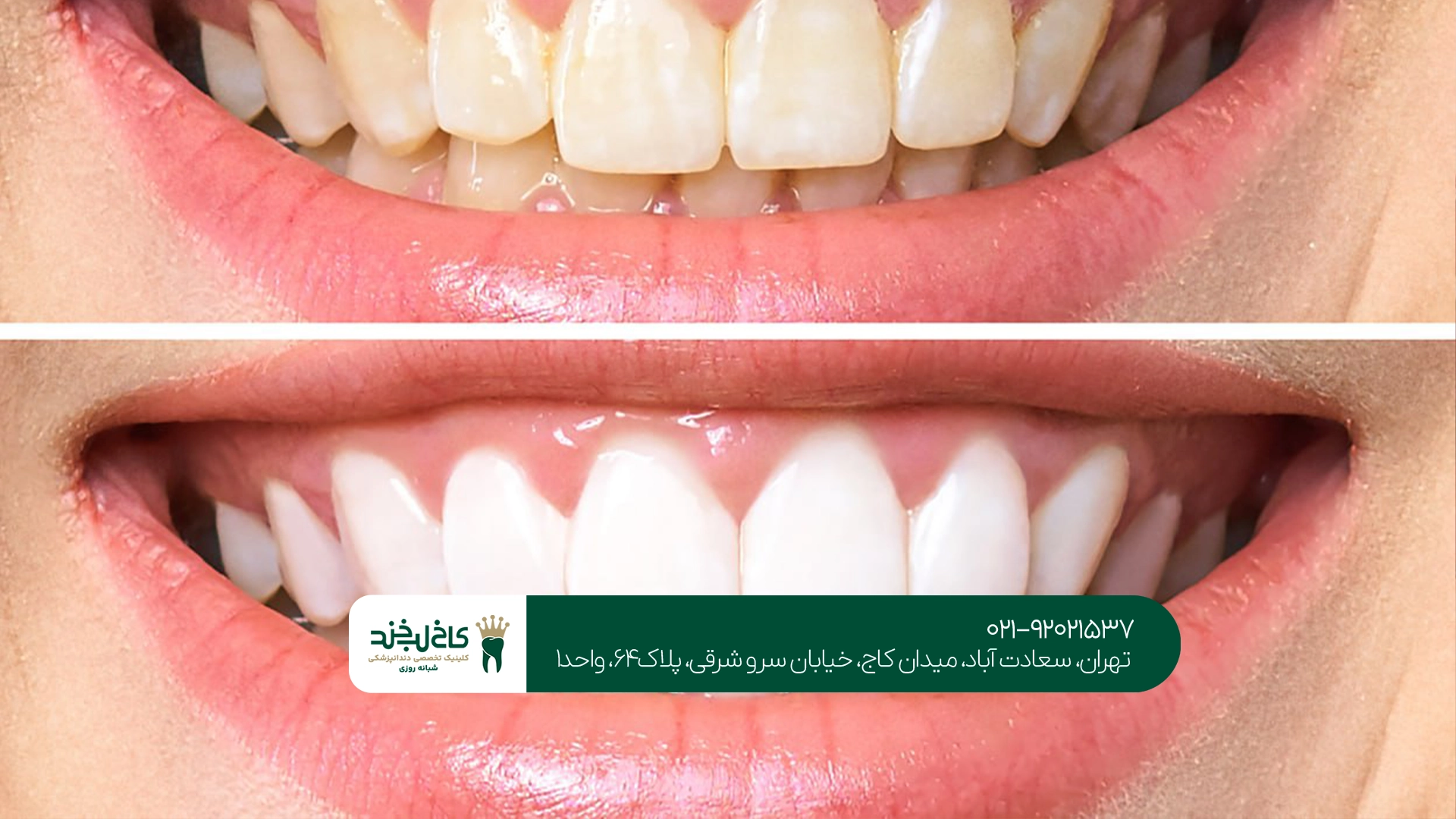 بلیچینگ دندان در خانه چطور انجام میشود؟